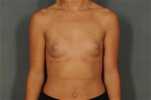 Breast Augmentation Before Photo by Ellen Janetzke, MD; Bloomfield Hills, MI - Case 29763