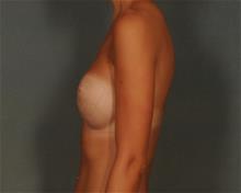 Breast Augmentation After Photo by Ellen Janetzke, MD; Bloomfield Hills, MI - Case 29763