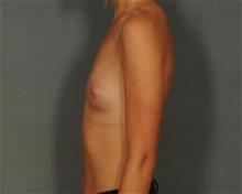 Breast Augmentation Before Photo by Ellen Janetzke, MD; Bloomfield Hills, MI - Case 29763