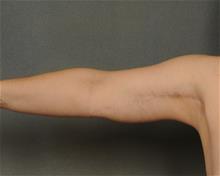 Arm Lift After Photo by Ellen Janetzke, MD; Bloomfield Hills, MI - Case 29769