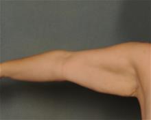 Arm Lift Before Photo by Ellen Janetzke, MD; Bloomfield Hills, MI - Case 29769