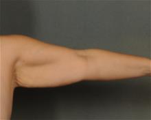 Arm Lift Before Photo by Ellen Janetzke, MD; Bloomfield Hills, MI - Case 29769