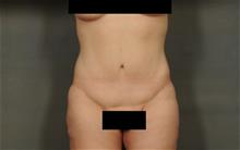 Tummy Tuck After Photo by Ellen Janetzke, MD; Bloomfield Hills, MI - Case 29771