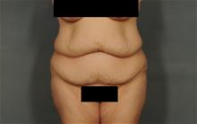 Tummy Tuck Before Photo by Ellen Janetzke, MD; Bloomfield Hills, MI - Case 29771