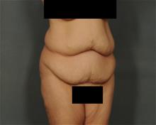 Tummy Tuck Before Photo by Ellen Janetzke, MD; Bloomfield Hills, MI - Case 29771