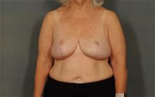Breast Reduction After Photo by Ellen Janetzke, MD; Bloomfield Hills, MI - Case 29801