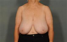 Breast Reduction Before Photo by Ellen Janetzke, MD; Bloomfield Hills, MI - Case 29801