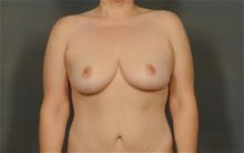 Breast Reduction After Photo by Ellen Janetzke, MD; Bloomfield Hills, MI - Case 29802