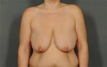 Breast Reduction Before Photo by Ellen Janetzke, MD; Bloomfield Hills, MI - Case 29802