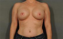 Breast Augmentation After Photo by Ellen Janetzke, MD; Bloomfield Hills, MI - Case 29804
