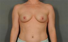 Breast Augmentation Before Photo by Ellen Janetzke, MD; Bloomfield Hills, MI - Case 29804