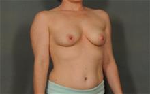 Breast Augmentation Before Photo by Ellen Janetzke, MD; Bloomfield Hills, MI - Case 29804