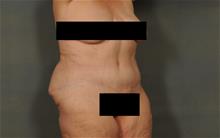 Tummy Tuck After Photo by Ellen Janetzke, MD; Bloomfield Hills, MI - Case 29805