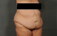 Tummy Tuck Before Photo by Ellen Janetzke, MD; Bloomfield Hills, MI - Case 29805