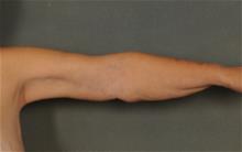 Arm Lift After Photo by Ellen Janetzke, MD; Bloomfield Hills, MI - Case 29806