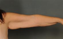 Arm Lift Before Photo by Ellen Janetzke, MD; Bloomfield Hills, MI - Case 29806