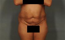 Tummy Tuck Before Photo by Ellen Janetzke, MD; Bloomfield Hills, MI - Case 29819