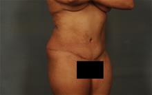 Tummy Tuck After Photo by Ellen Janetzke, MD; Bloomfield Hills, MI - Case 29819