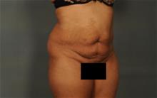 Tummy Tuck Before Photo by Ellen Janetzke, MD; Bloomfield Hills, MI - Case 29819