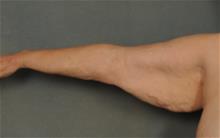 Arm Lift Before Photo by Ellen Janetzke, MD; Bloomfield Hills, MI - Case 29873