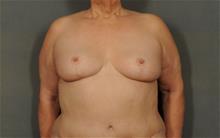 Breast Reduction After Photo by Ellen Janetzke, MD; Bloomfield Hills, MI - Case 29874