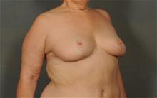 Breast Reduction After Photo by Ellen Janetzke, MD; Bloomfield Hills, MI - Case 29874