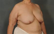 Breast Reduction Before Photo by Ellen Janetzke, MD; Bloomfield Hills, MI - Case 29874