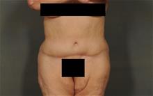 Tummy Tuck After Photo by Ellen Janetzke, MD; Bloomfield Hills, MI - Case 29875