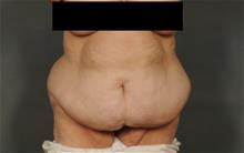Tummy Tuck Before Photo by Ellen Janetzke, MD; Bloomfield Hills, MI - Case 29875