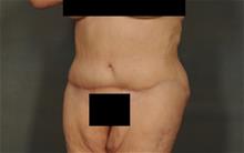 Tummy Tuck After Photo by Ellen Janetzke, MD; Bloomfield Hills, MI - Case 29875