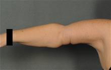 Arm Lift After Photo by Ellen Janetzke, MD; Bloomfield Hills, MI - Case 29963