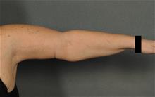 Arm Lift After Photo by Ellen Janetzke, MD; Bloomfield Hills, MI - Case 29963