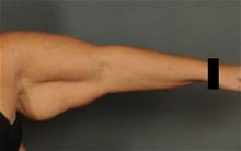 Arm Lift Before Photo by Ellen Janetzke, MD; Bloomfield Hills, MI - Case 29963