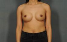 Breast Augmentation After Photo by Ellen Janetzke, MD; Bloomfield Hills, MI - Case 29964