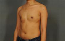 Breast Augmentation Before Photo by Ellen Janetzke, MD; Bloomfield Hills, MI - Case 29964