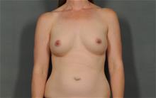 Breast Augmentation After Photo by Ellen Janetzke, MD; Bloomfield Hills, MI - Case 29965