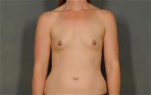 Breast Augmentation Before Photo by Ellen Janetzke, MD; Bloomfield Hills, MI - Case 29965