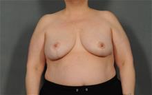 Breast Reduction After Photo by Ellen Janetzke, MD; Bloomfield Hills, MI - Case 29967