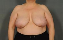 Breast Reduction Before Photo by Ellen Janetzke, MD; Bloomfield Hills, MI - Case 29967