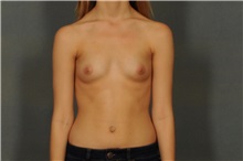Breast Augmentation Before Photo by Ellen Janetzke, MD; Bloomfield Hills, MI - Case 30465