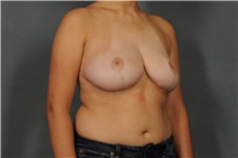 Breast Reduction After Photo by Ellen Janetzke, MD; Bloomfield Hills, MI - Case 30467