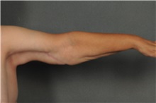 Arm Lift After Photo by Ellen Janetzke, MD; Bloomfield Hills, MI - Case 30468