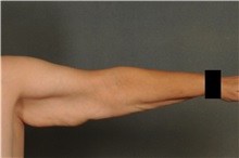 Arm Lift Before Photo by Ellen Janetzke, MD; Bloomfield Hills, MI - Case 30468