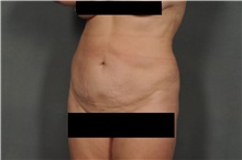 Liposuction After Photo by Ellen Janetzke, MD; Bloomfield Hills, MI - Case 30469