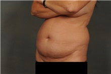 Liposuction Before Photo by Ellen Janetzke, MD; Bloomfield Hills, MI - Case 30469