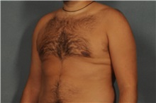 Male Breast Reduction After Photo by Ellen Janetzke, MD; Bloomfield Hills, MI - Case 30590