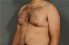 Male Breast Reduction Before Photo by Ellen Janetzke, MD; Bloomfield Hills, MI - Case 30590
