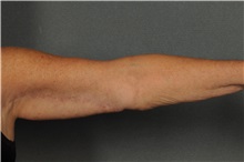Arm Lift After Photo by Ellen Janetzke, MD; Bloomfield Hills, MI - Case 30788