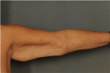 Arm Lift Before Photo by Ellen Janetzke, MD; Bloomfield Hills, MI - Case 30788