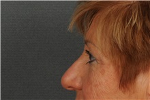 Eyelid Surgery After Photo by Ellen Janetzke, MD; Bloomfield Hills, MI - Case 30789